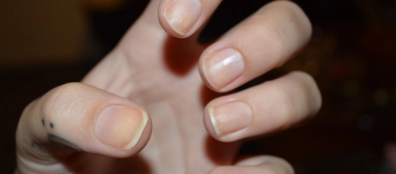 Πέντε προβλήματα υγείας που φαίνονται στα νύχια - Αλλάζουν όψη και σύσταση